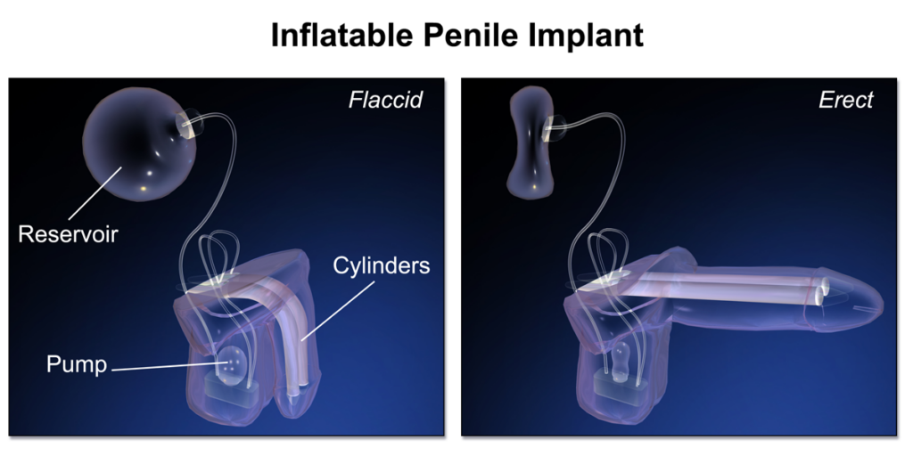 Illustration of an inflatable penile implant.